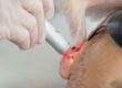 Auriculoterapia cu laser laserOstop renunțare la fumat oprirea fumatului